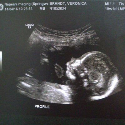 Monica via ultrasound